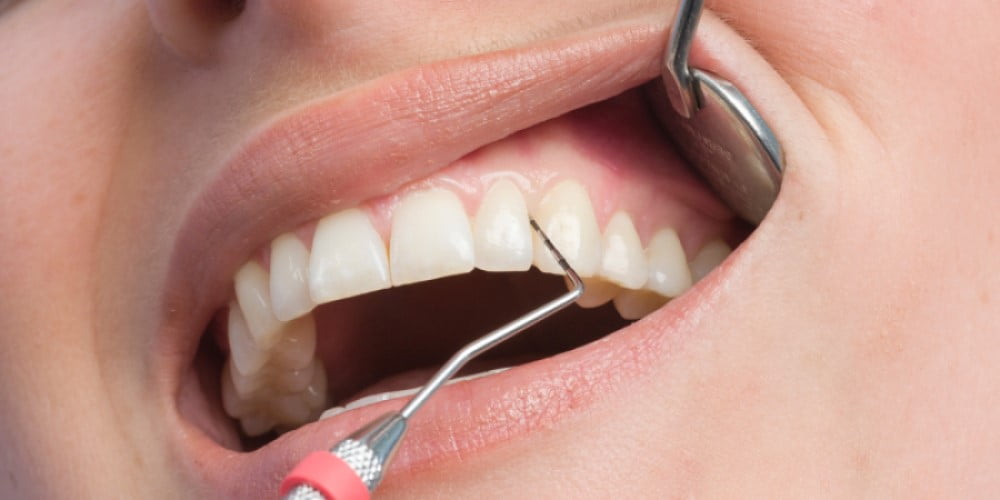 Diş Eti Hastalıkları ve Tedavisi • DentaVina Diş Kliniği - Suadiye, Kadıköy