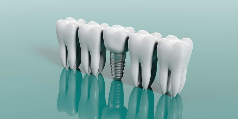 Dental İmplant Tedavisi Pahalı Bir Tedavi midir?